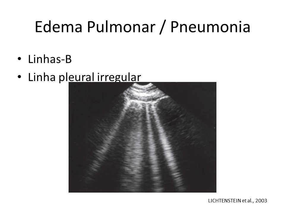 Imagem de ultrassom mostra marcas em pulmão com edema causado pelo coronavírus (Divulgação)