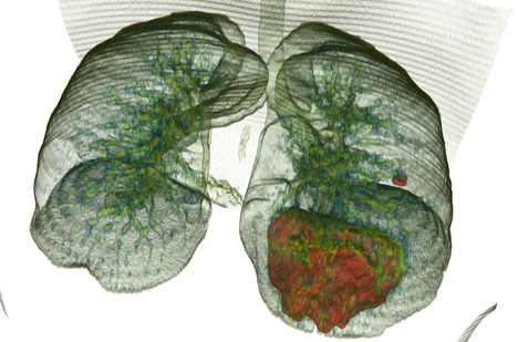 Modelos 3D com máscaras de segmentação, destacando a área do pulmão comprometida pela COVID-19 (Foto: Arquivo pessoal)