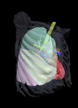 Avaliação do Volume e Acometimento Pulmonar através de Imagens 3D (Foto: Arquivo pessoal)