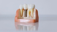 Nova técnica acelera testes de materiais e apoia o desenvolvimento de implantes dentários