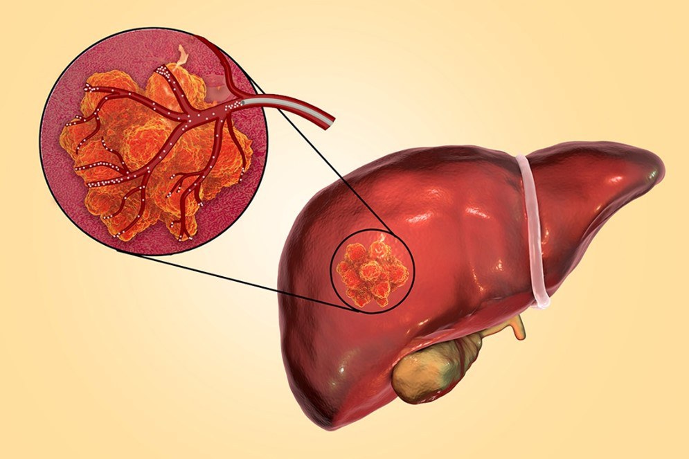 Imagem ilustrativa demostrando a aplicação das microesferas de vidro dopadas durante a radioembolização. (Ilustração: Mário Lima - IPEN/CNEN)