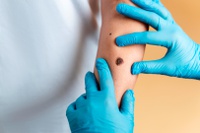 Câncer de pele: Prevenção deve ser iniciada na infância, evitando-se a exposição direta ao sol entre 10h e 16h