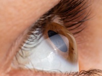 Ceratocone não tem cura, mas tem controle. Diagnóstico precoce é importante