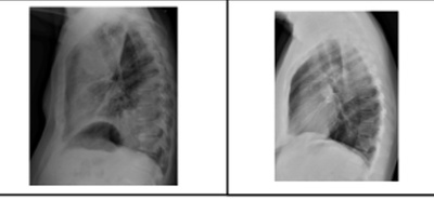 HCPA