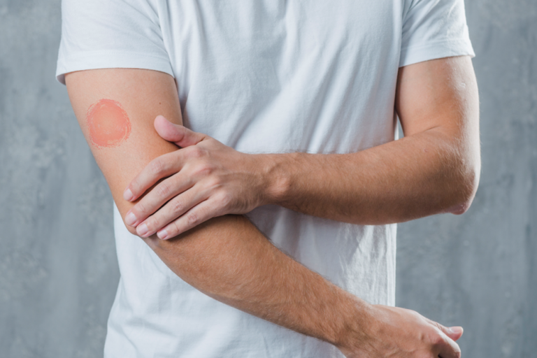 15012019 hanseníase hu-ufs redimensionado.png