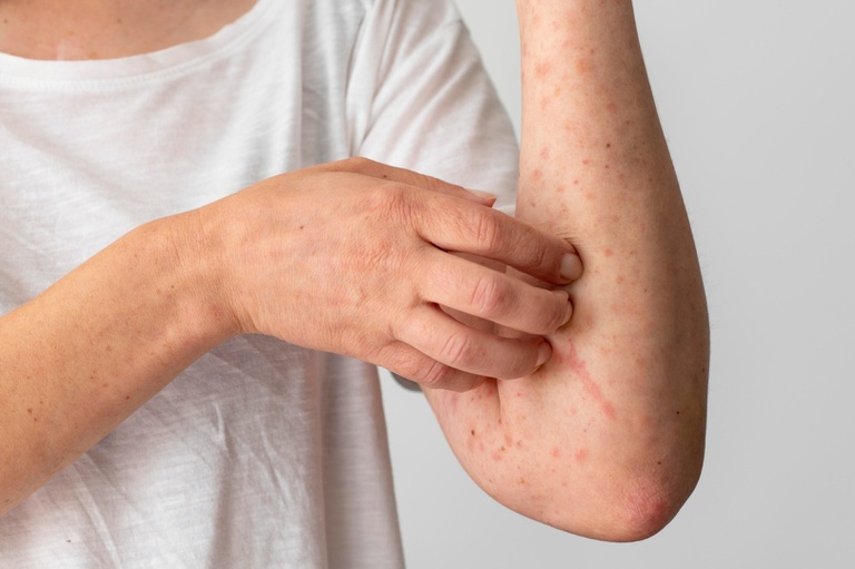 24062024 ebserh alergia alimentar.jpg