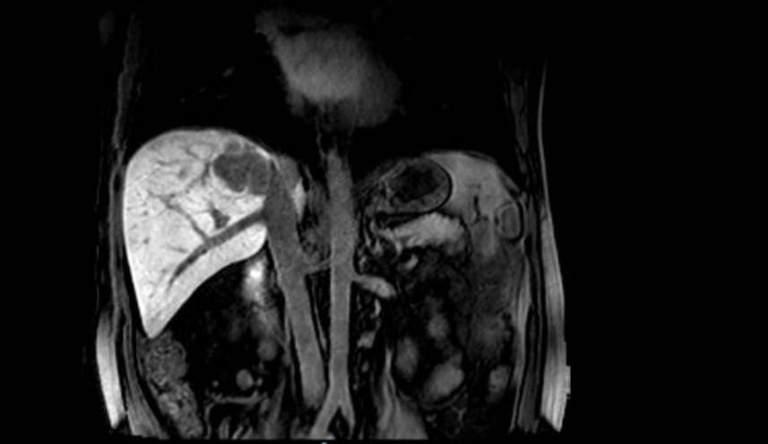 01022024 artigo cirurgia digestiva revista internacional ebserh