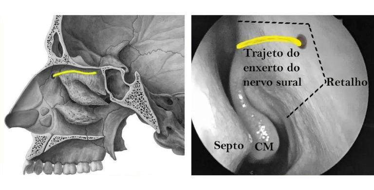 25042023 cirurgia olfato.png