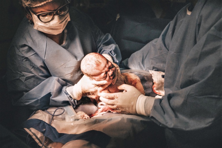 09022023 gastrosquise huap.jpg