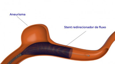 Imagem de aneurisma cerebral já com diversor de fluxo
