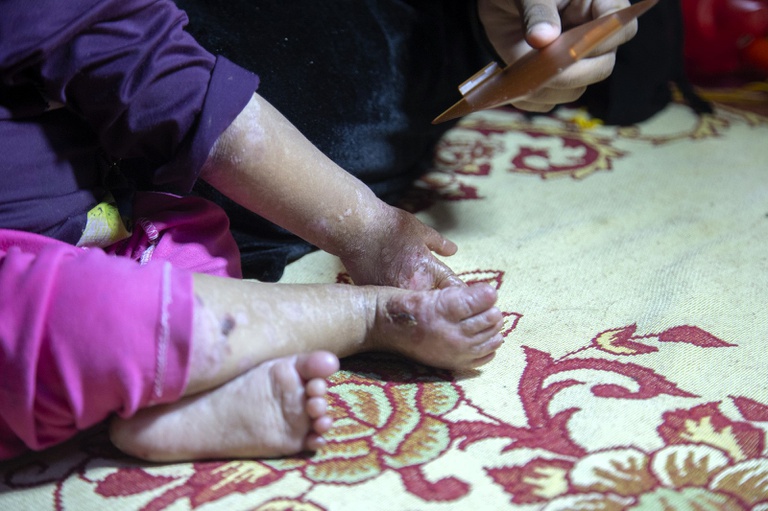 06122023 epidermólise bolhosa - 3.jpeg