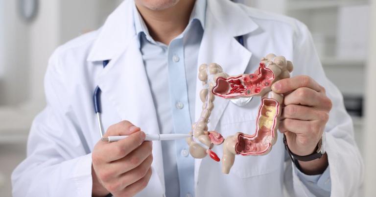 20052025 Doenças inflamatórias intestinais, Tratamento controla os sintomas e melhora a vida do paciente 1.jpg