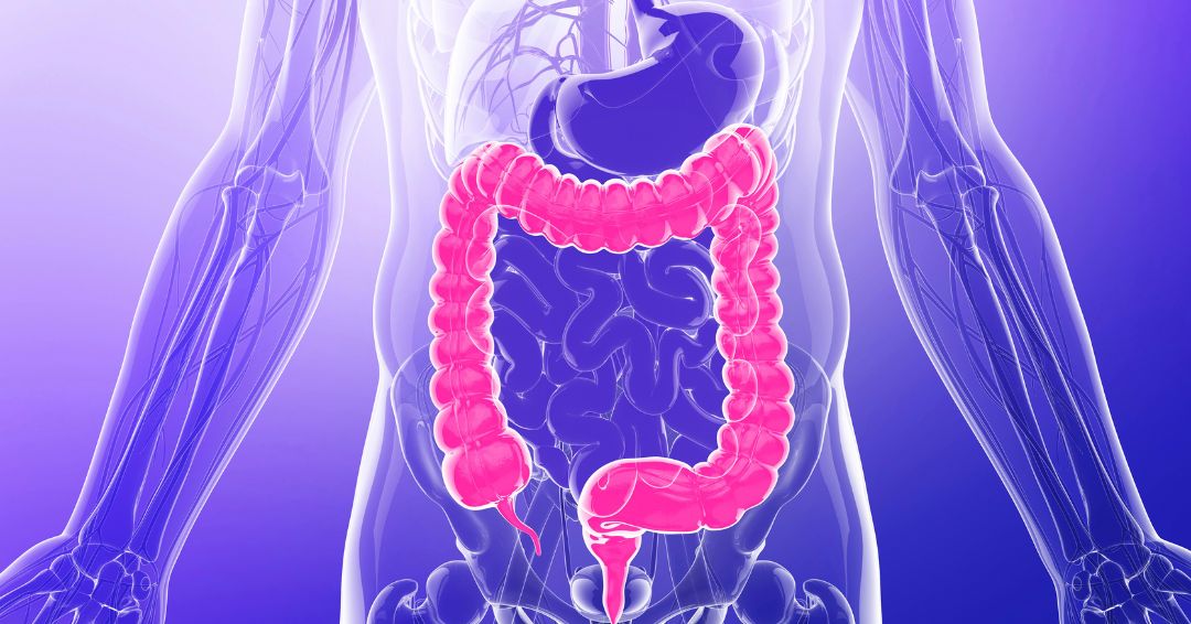 Doenças inflamatórias intestinais afetam cerca de 10 milhões de pessoas no mundo.