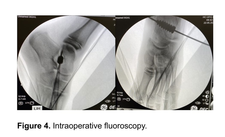 13052024 ebserh hc-ufg artigo pé chato 2.jpeg