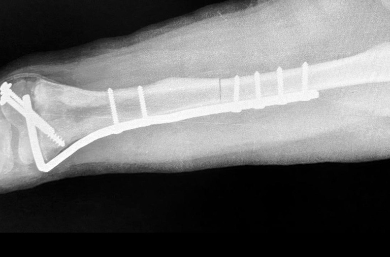 13082020 transplante hc-uftm.jpg