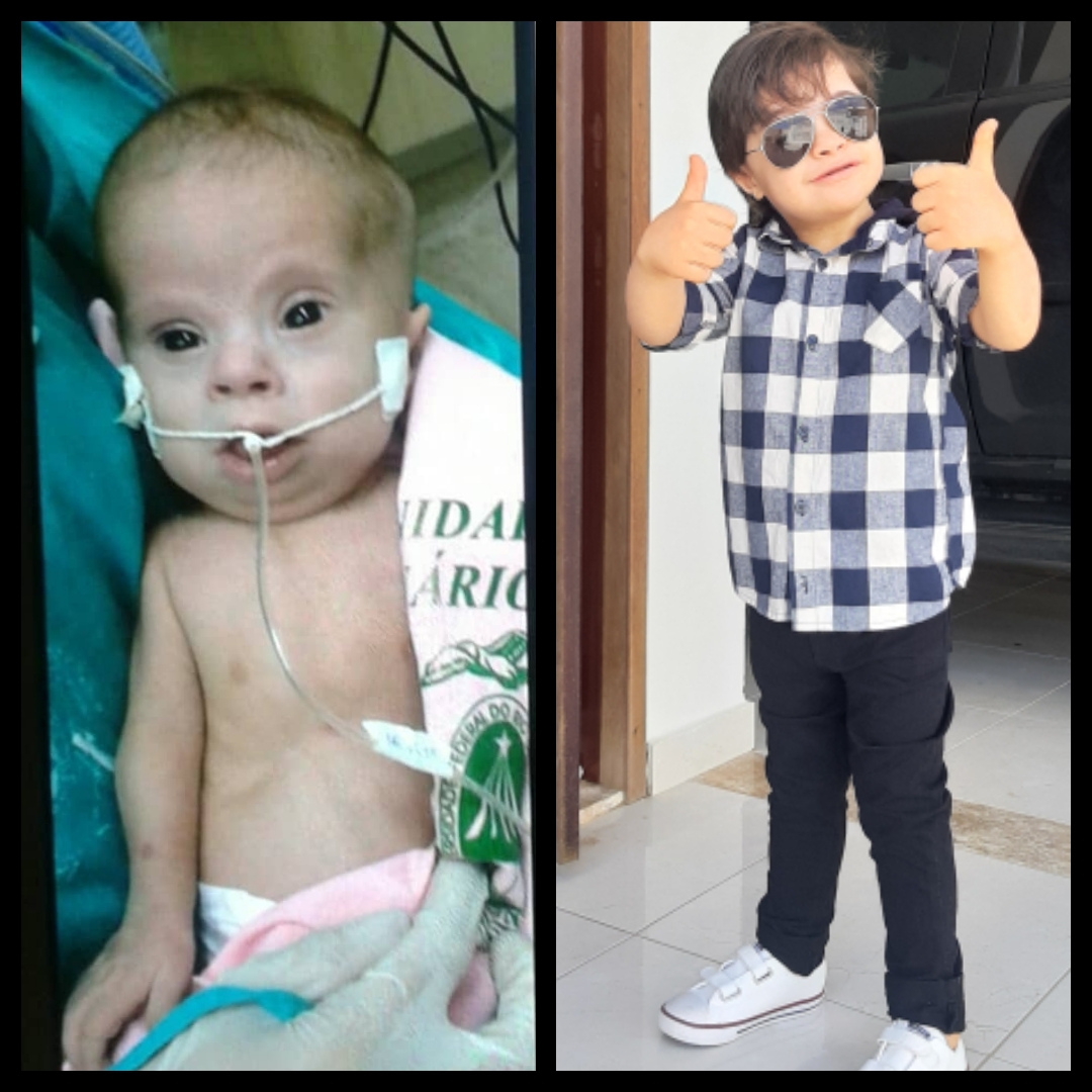Guilherme, ao nascer, e hoje, aos seis anos, curado de um cardiopatia congênita