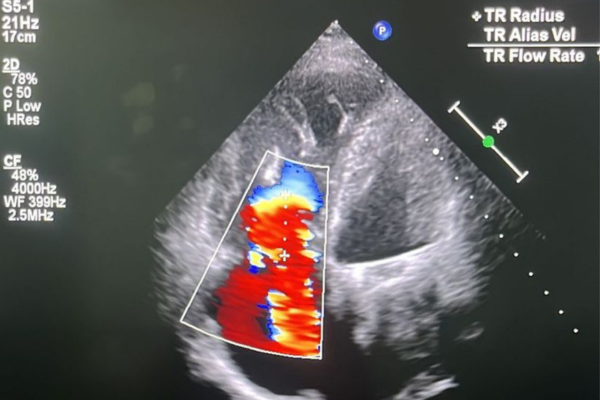 02062025 ebserh hc-ufpe válvula cardíaca 4.png