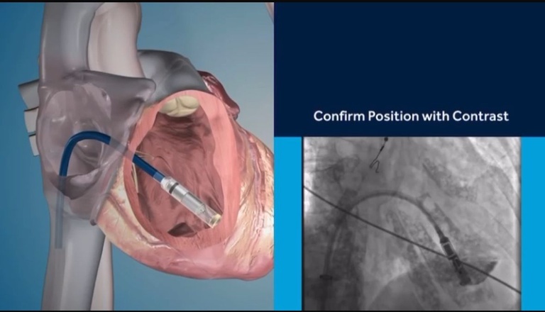 06032025 Hospital da Ebserh no Piauí realiza primeiro implante do menor marca-passo do mundo 4.jpeg