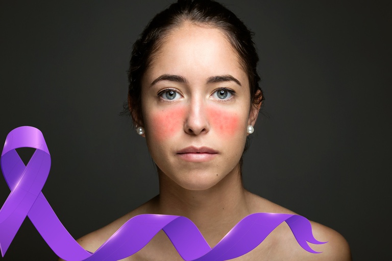 25052022 lúpus hulw-ufpb.jpg