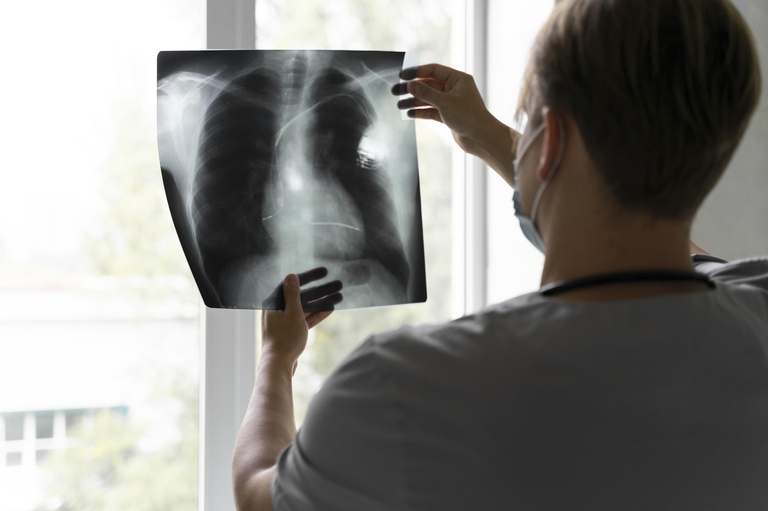 19032024 angioplastia pulmonar ebserh hu-ufsc