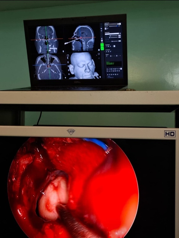 13082025 ebserh hu-ufpi cirurgia tumor cerebral 3.jpeg