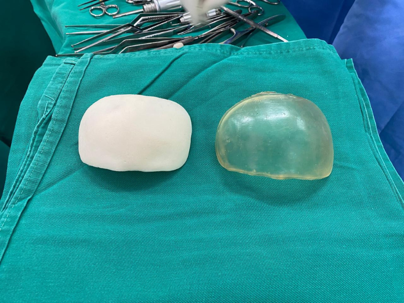 Osso frontal do crânio foi reconstituído com o auxílio do molde impresso em 3D