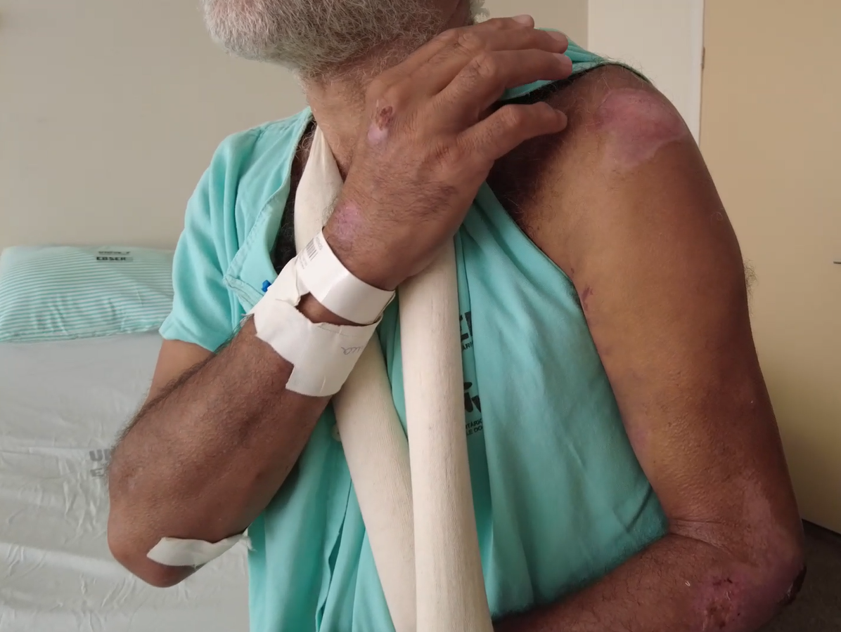 Paciente que sofreu acidente de trânsito durante tratamento no HU-Univasf.