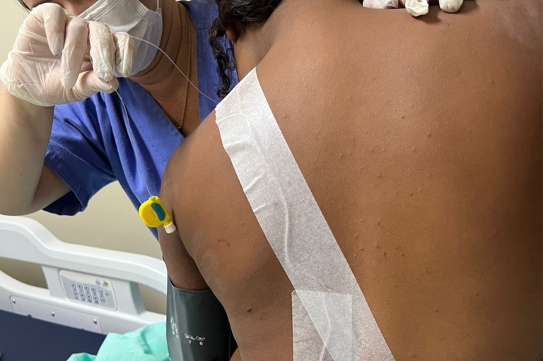 25072023 ebserh huab técnica analgesia 1.jpg