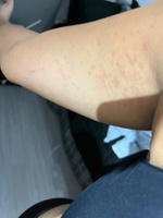 08072026 hubrasil dia mundial alergia 2.jpeg