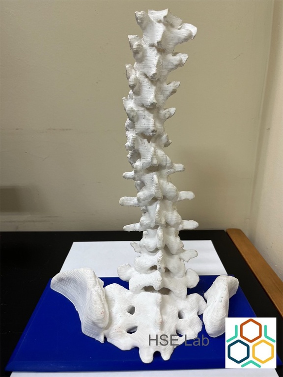 02082024 ebserh implante 3d 2.jpg