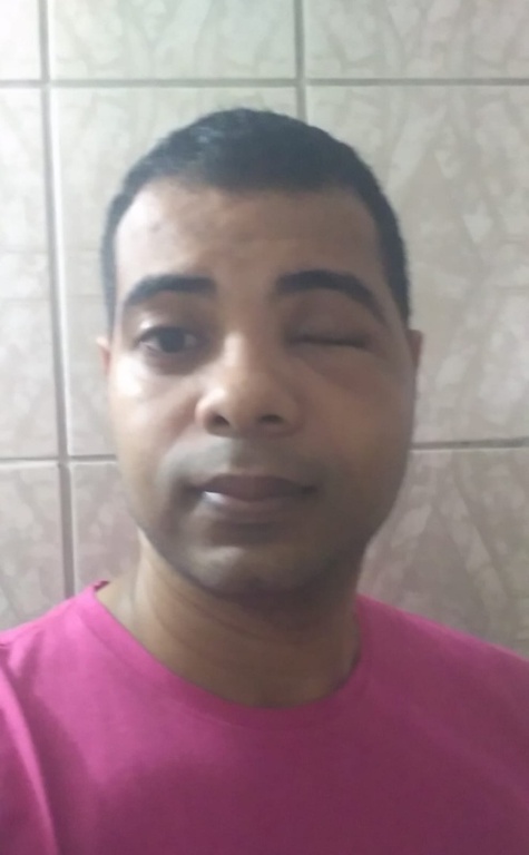 02082024 ebserh implante 3d 9.jpeg