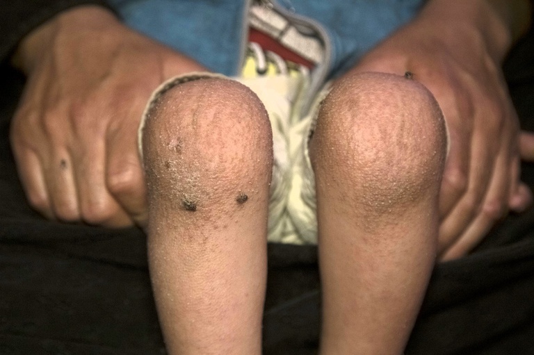 06122023 epidermólise bolhosa - 1.jpeg