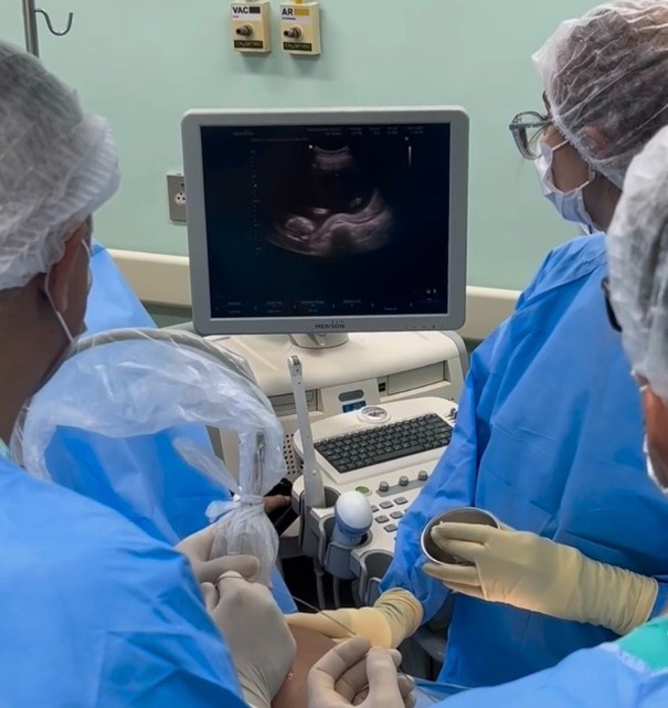 31032025 ebserh ch-ufrj stff placenta única