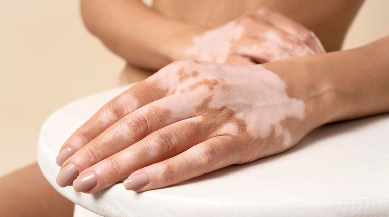 Vitiligo.png