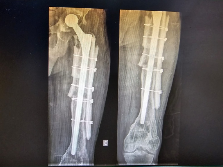 Transplante ósseo no HU-UFMA (1).jpeg