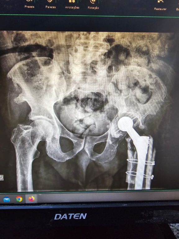 Transplante ósseo no HU-UFMA (2).jpeg