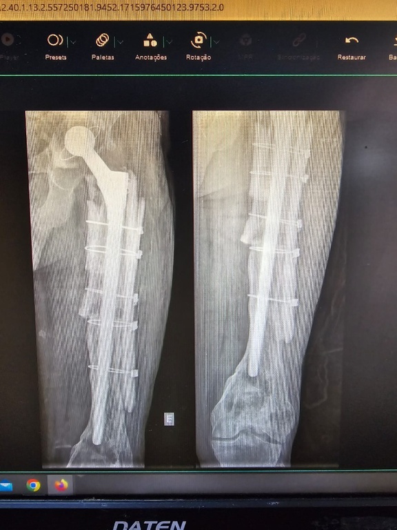 Transplante ósseo no HU-UFMA (3).jpeg