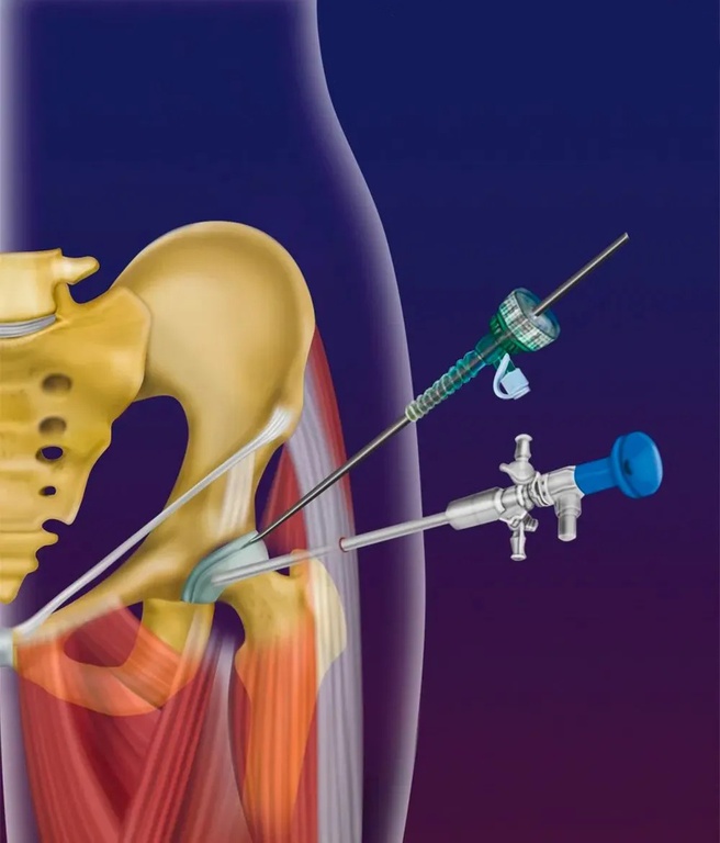 Denervação Percutânea