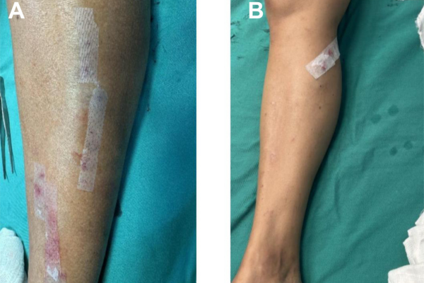 Estudo publicado sobre curativo a partir da cana de açúcar - site.png
