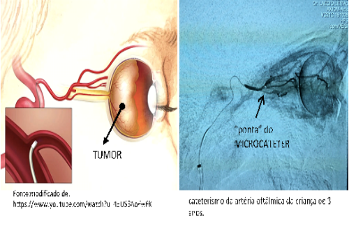 quimiopararetinoblastoma28png29
