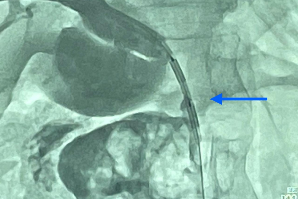 Ablação percutânea para tratamento de paciente com  câncer hepatobiliar- site (1).png