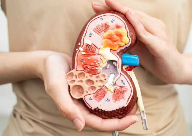 Câncer de rim: mitos e verdades sobre uma doença que pode evoluir em silêncio