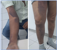 HU-Univasf diagnostica caso raro de hemofilia adquirida: relato foi publicado em revista científica internacional