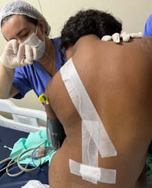 Procedimento Analgesia Parto Huab