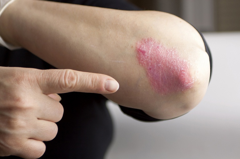 psoriase.jpeg