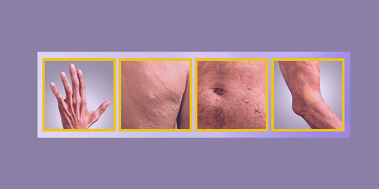 Janeiro Roxo conscientiza sobre a hanseníase