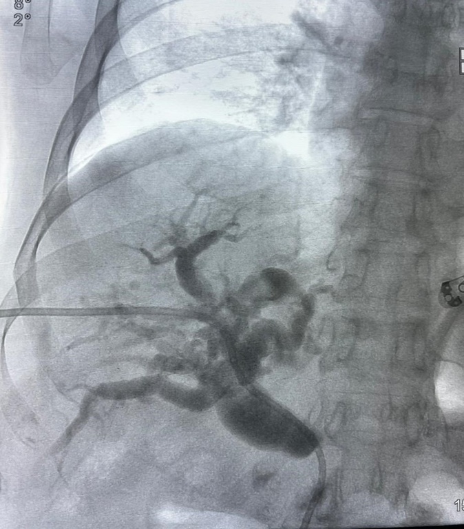 drenagem biliar.jpeg