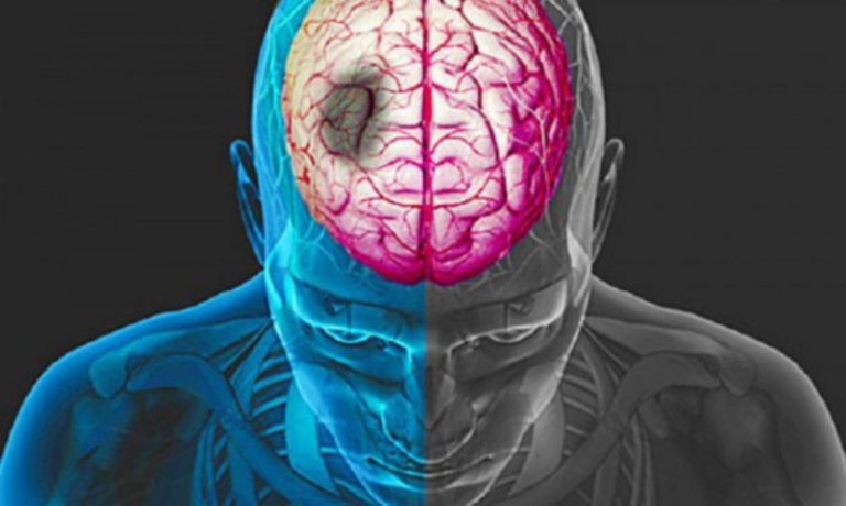 avc-cerebro-870x522.jpg