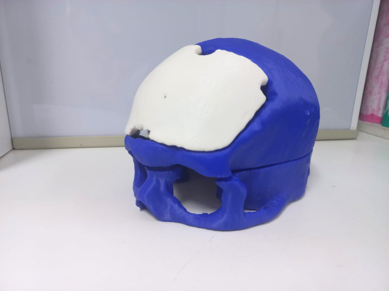 neurocirurgia prótese