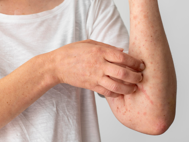 alergia alimentar hugg